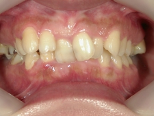 矯正歯科　治療前