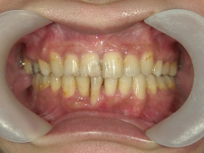 矯正歯科　全顎ワイヤー矯正　治療後