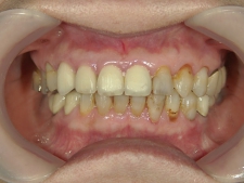 矯正歯科　プチワイヤー矯正　治療後