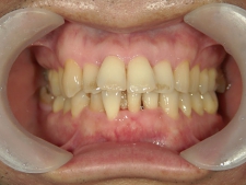 矯正歯科　治療前