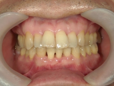 矯正歯科　プチワイヤー矯正　治療後