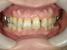 矯正歯科　治療前