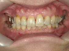 矯正歯科　プチワイヤー矯正　治療後