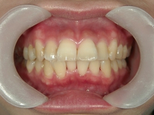 矯正歯科　治療前