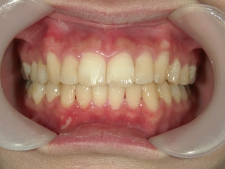 矯正歯科　プチワイヤー矯正　治療後