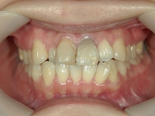 矯正歯科　治療前