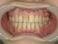 矯正歯科　プチワイヤー矯正　治療後