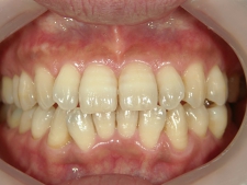 矯正歯科　治療前