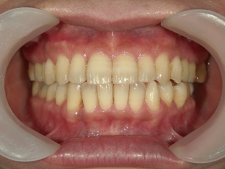 矯正歯科　プチワイヤー矯正　治療後