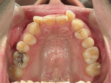 矯正歯科　治療前