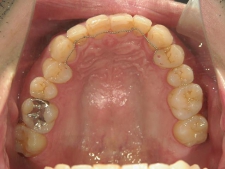 矯正歯科　プチワイヤー矯正　治療後