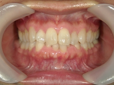 矯正歯科　治療前