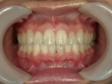 矯正歯科　プチワイヤー矯正　治療後