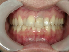 矯正歯科　治療前