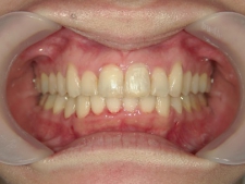 矯正歯科　プチワイヤー矯正　治療後