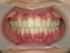 矯正歯科　プチワイヤー矯正　治療後