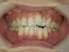 矯正歯科　治療前