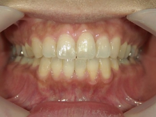 矯正歯科　プチワイヤー矯正　治療後