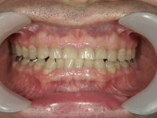 矯正歯科　治療前