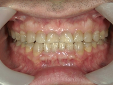 矯正歯科　プチワイヤー矯正　治療後