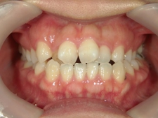 矯正歯科　治療前