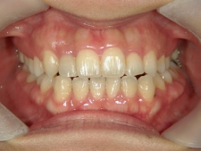 矯正歯科　プチワイヤー矯正　治療後