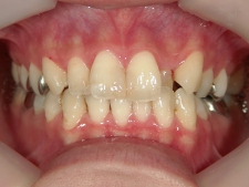 矯正歯科　治療前