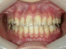 矯正歯科　全顎ワイヤー矯正　治療後