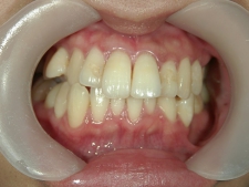 矯正歯科　全顎ワイヤー矯正　治療後