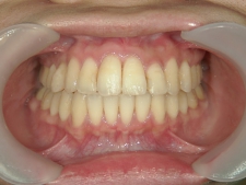 矯正歯科　全顎ワイヤー矯正　治療後