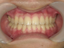 矯正歯科　全顎ワイヤー矯正　治療後